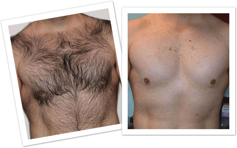 permanent hair removal for the man