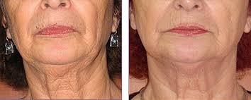 rf-treatment-before-and-after